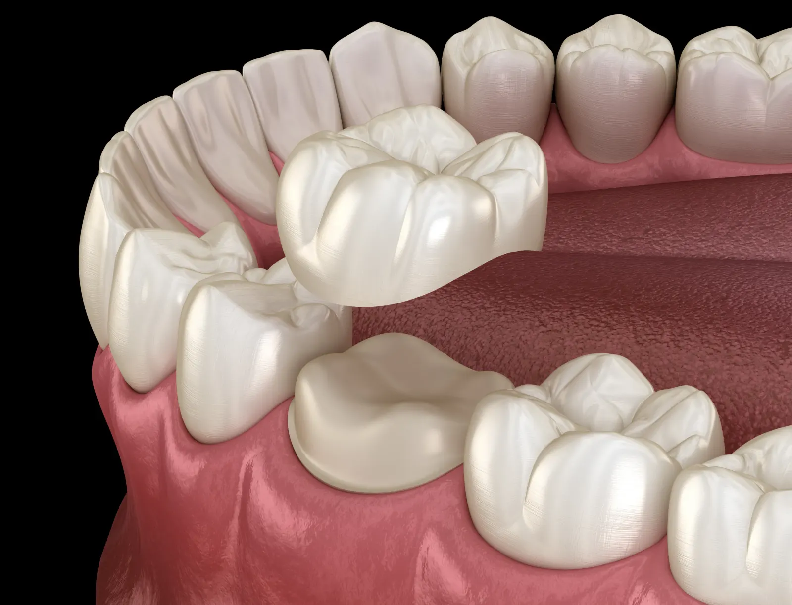 Dental Crowns