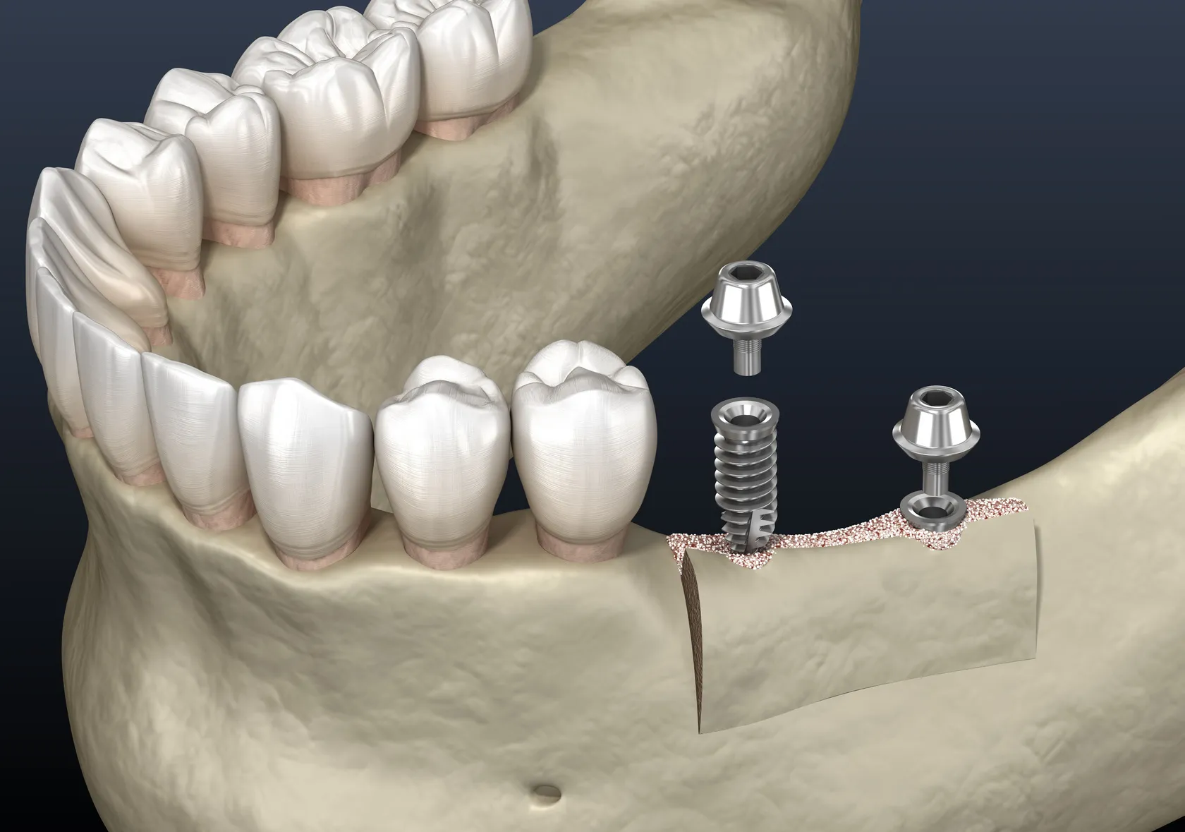 Ridge Augmentation