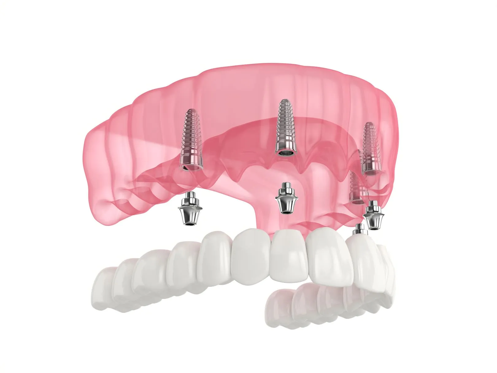 Restorative Dentistry at Foothills Family Dental