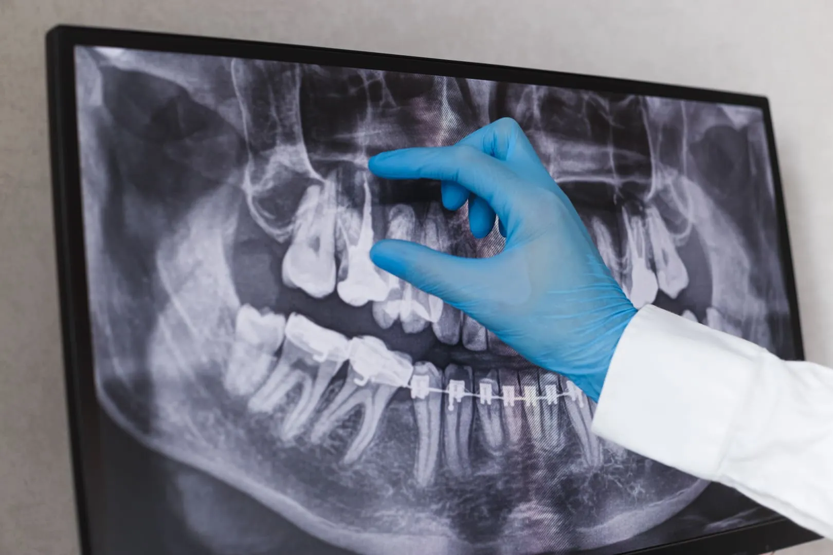 Root Canals