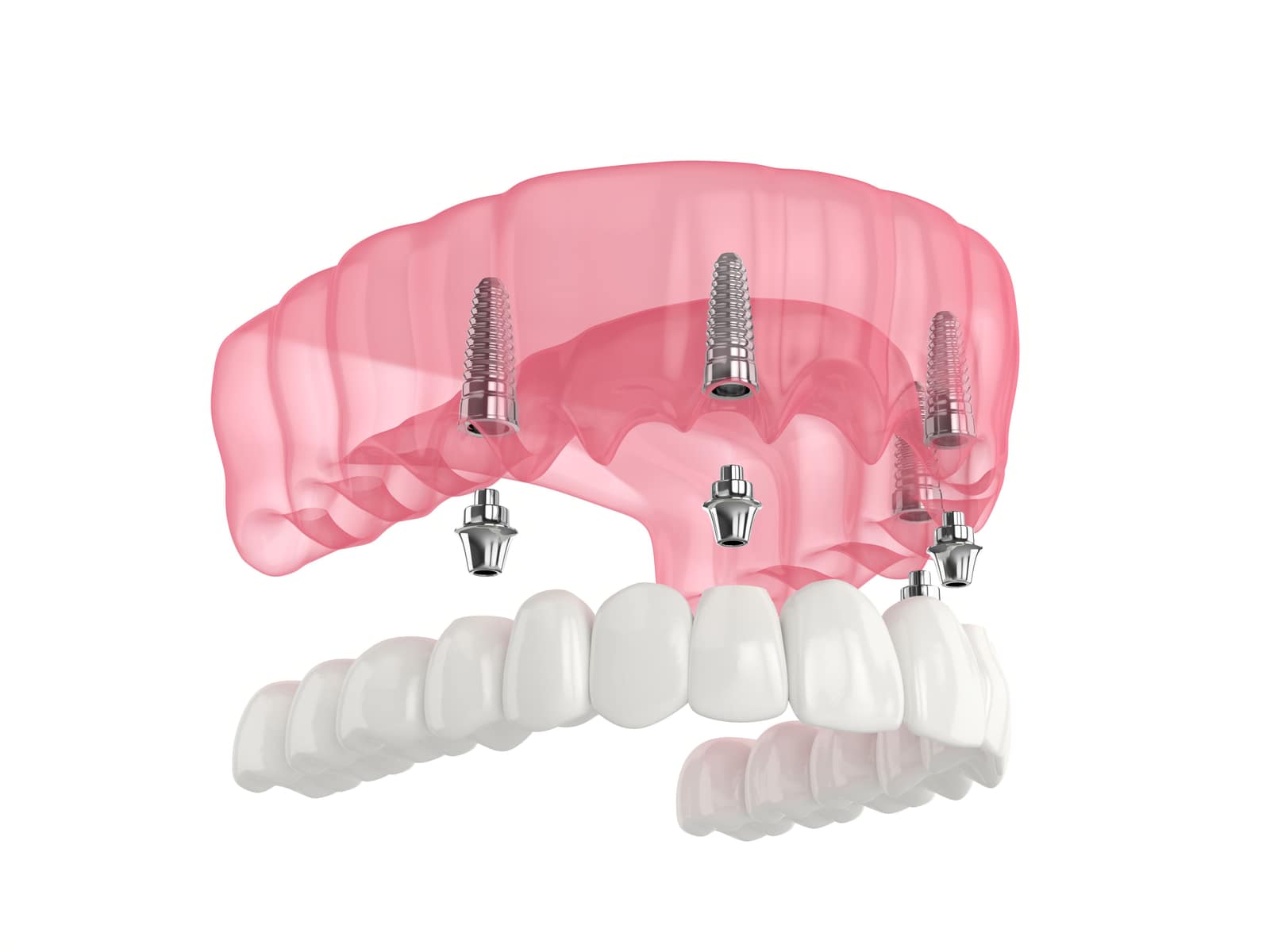 All-on-4 Dental Implants in Fort Collins: The Complete Patient Guide