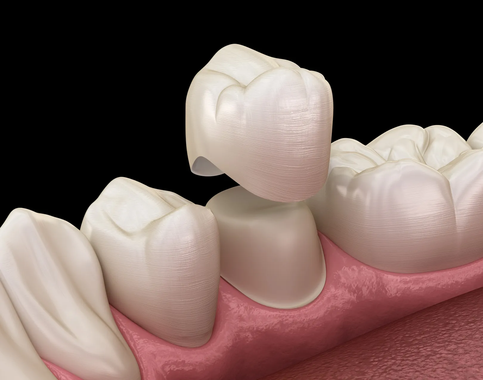 Dental Crowns at Foothills Family Dental