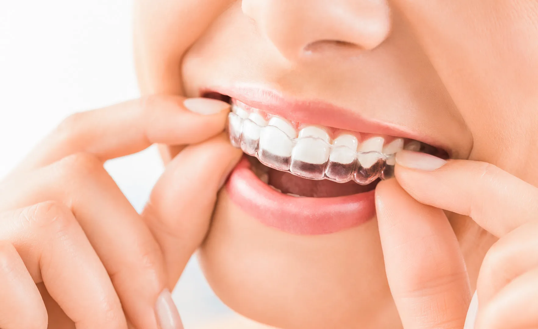 Invisalign at Foothills Family Dental