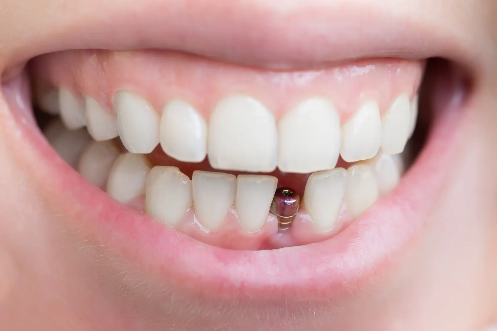 Single Tooth Implants at Foothills Family Dental